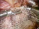 Laparoscopic hernia repair